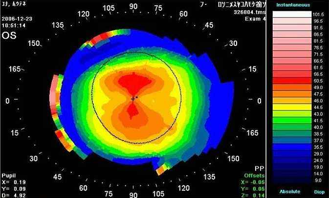 角膜地形图.png